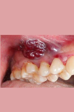 Oral Cancer Picture